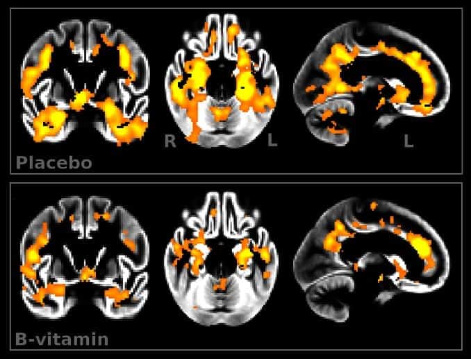 Regional loss of grey matter volume in placebo and B-vitamin groups.